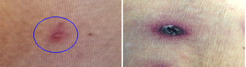 (사진 왼쪽부터) 작은소피참진드기에 물린 후 피부발진(SFTS) 및 가피(쯔쯔가무시증) 모습. 자료사진